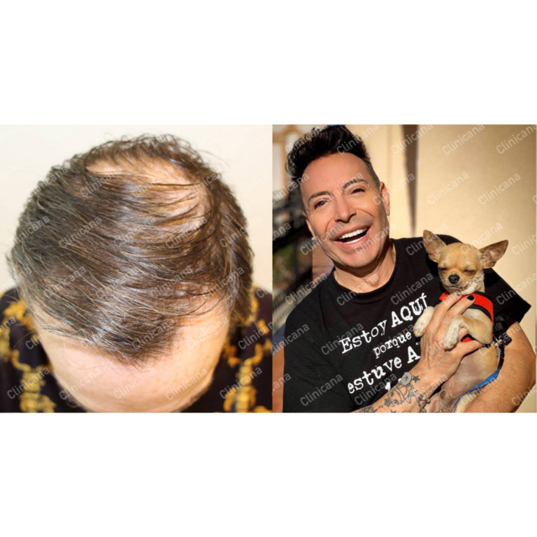 How Many Grafts Do I Need? Estimating Your Hair Transplant Graft Count